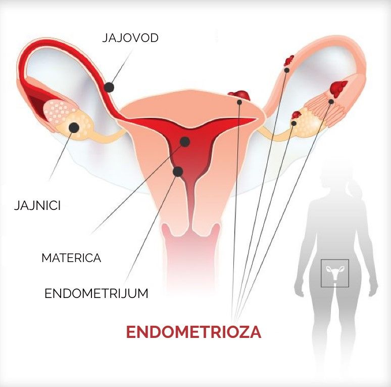 EDNOMETRIOZA – simptomi, dijagnoza, liječenje, neplodnost